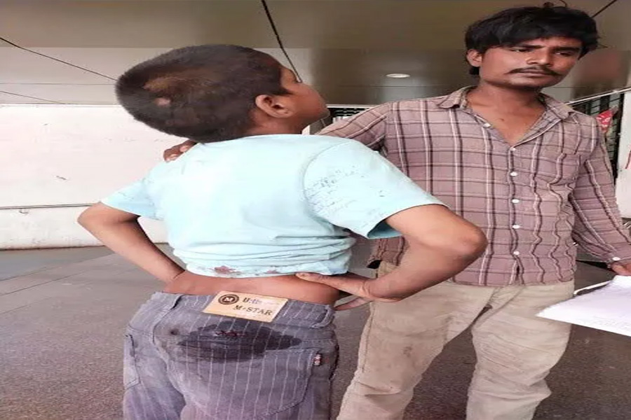 Surat: Terror of stray dogs continues in the city, three children were bitten by dogs