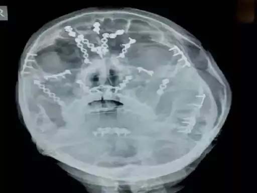 The bones of the face were shattered, the doctors gave a new life to the young man