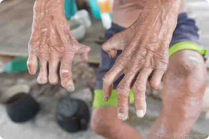 Netra Jyoti and leprosy search campaign will run for 26 days in the district