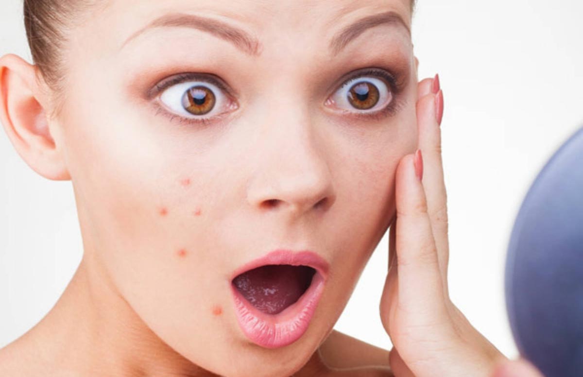 Pimples and stubborn black spots have come on the face?